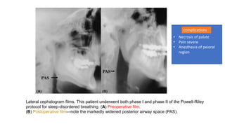 Lateral cephalogram films. This patient underwent both phase I and phase II of the Powell-Riley
protocol for sleep-disordered breathing. (A) Preoperative film.
(B) Postoperative film—note the markedly widened posterior airway space (PAS).
• Necrosis of palate
• Pain severe
• Anesthesia of peioral
region
complications
 
