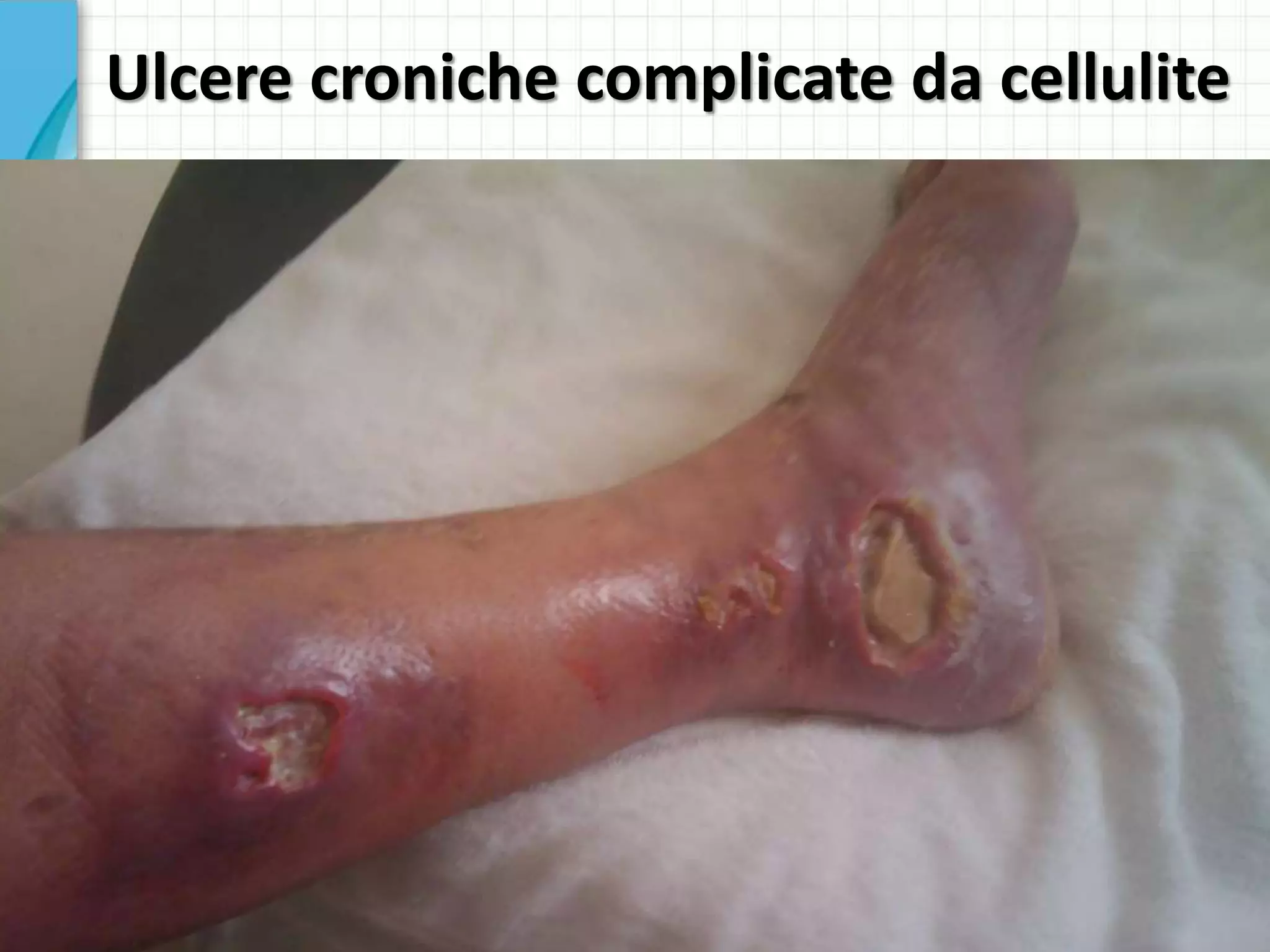 Diagnosi e terapia di erisipela e cellulite nel linfedema cronico | PPTX, image size:2048x1536
