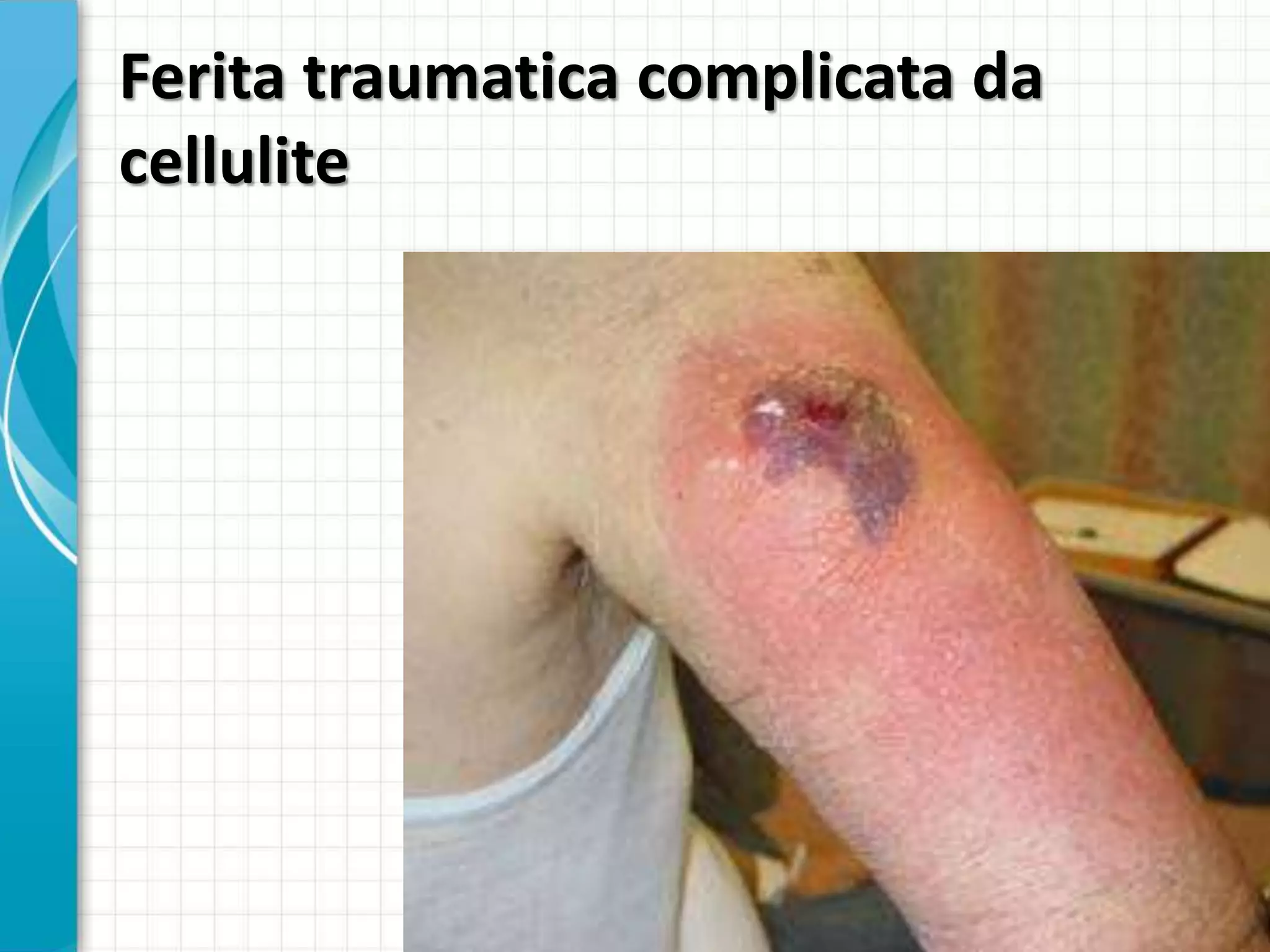 Diagnosi e terapia di erisipela e cellulite nel linfedema cronico | PPTX, image size:2048x1536