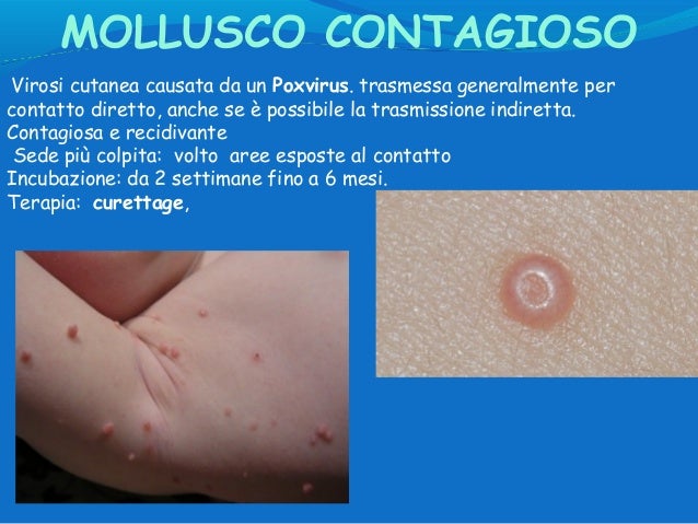 terapia mollusco contagioso bambini