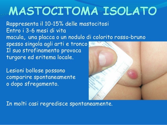 Come defluisce a psoriasi