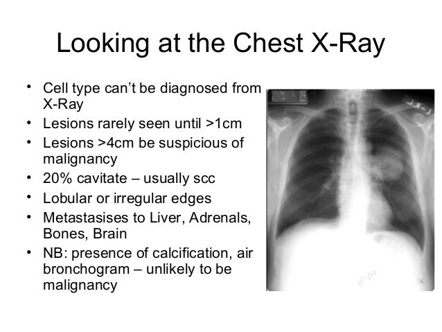 Diagnosing Lung cancer