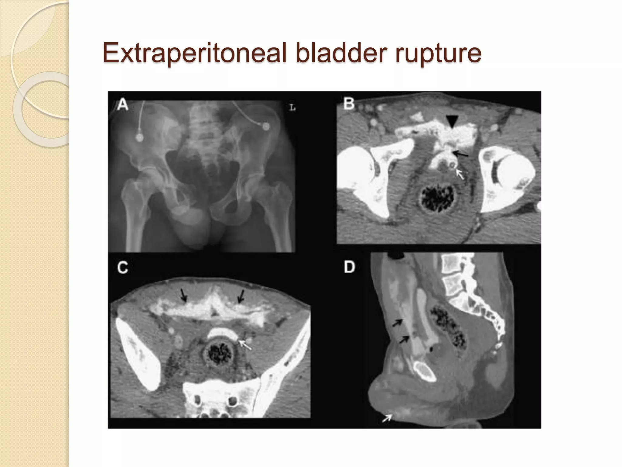 Extraperitoneal bladder rupture
 