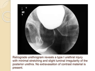 Urethrogram Injury Dx & Mx of urethral and bladder injuries | PPTX