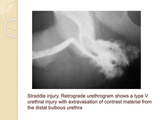 Urethrogram Injury Dx & Mx of urethral and bladder injuries | PPTX