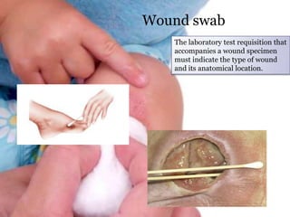 Wound swab
The laboratory test requisition that
accompanies a wound specimen
must indicate the type of wound
and its anatomical location.
 