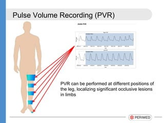 Measuring Pvr Diagnosing peripheral arterial disease and assessing degree of ischemia ...