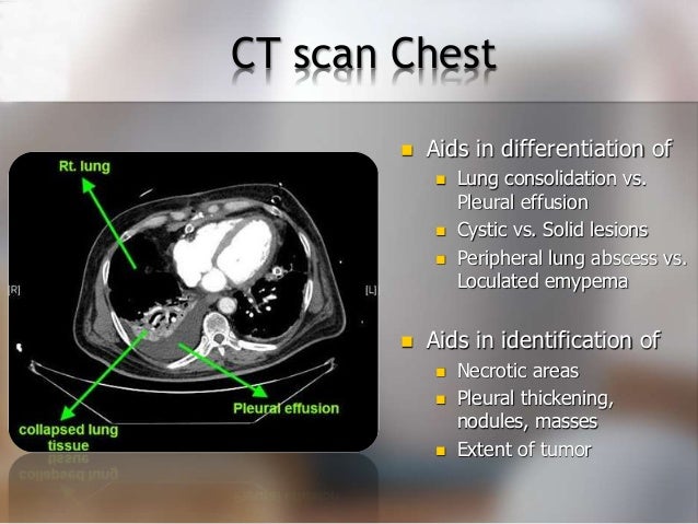 Diagnosing pleural effusion