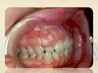 Exophytic lesion in the oral cavity | PPT