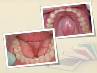 Exophytic lesion in the oral cavity | PPT