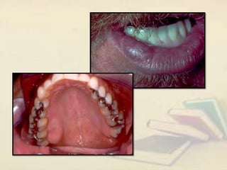 Exophytic lesion in the oral cavity | PPT
