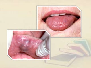 Exophytic lesion in the oral cavity | PPT
