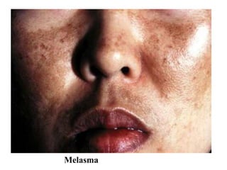 Melasma
 