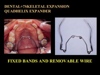 DENTAL+?SKELETAL EXPANSION
QUADHELIX EXPANDER

FIXED BANDS AND REMOVABLE WIRE

 