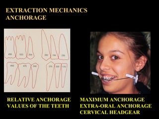 EXTRACTION MECHANICS
ANCHORAGE

RELATIVE ANCHORAGE
VALUES OF THE TEETH

MAXIMUM ANCHORAGE
EXTRA-ORAL ANCHORAGE
CERVICAL HE...
