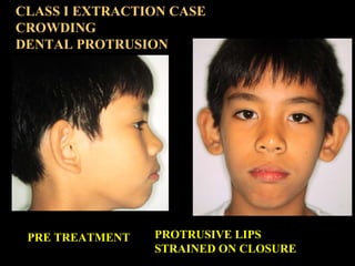 CLASS I EXTRACTION CASE
CROWDING
DENTAL PROTRUSION

PRE TREATMENT

PROTRUSIVE LIPS
STRAINED ON CLOSURE

 