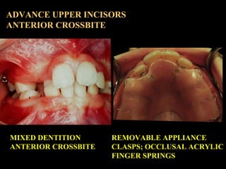 ADVANCE UPPER INCISORS
ANTERIOR CROSSBITE

MIXED DENTITION
ANTERIOR CROSSBITE

REMOVABLE APPLIANCE
CLASPS; OCCLUSAL ACRYLI...
