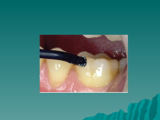 Requirements of Endodontic Films
 Show  4-5 mm beyond the apex of the
  tooth and the surrounding bone or
  pathologic co...