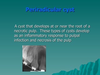 Visit 2:
 Working length determination

 Debridement using the hybrid technique

 Irrigation

 Placed intra-canal medi...