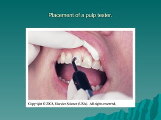Placement of a pulp tester.
 