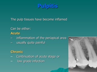 Pulpitis

The pulp tissues have become inflamed

Can be either:
Acute
– inflammation of the periapical area
– usually quite painful

Chronic
– Continuation of acute stage or
–   low grade infection
 