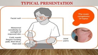 TYPICAL PRESENTATION
 