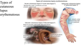 Types of
cutaneous
lupus
erythematosus
 