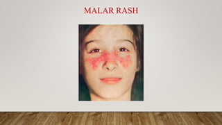 MALAR RASH
 