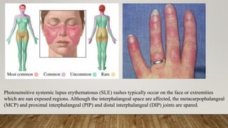 Photosensitive systemic lupus erythematosus (SLE) rashes typically occur on the face or extremities
which are sun exposed regions. Although the interphalangeal space are affected, the metacarpophalangeal
(MCP) and proximal interphalangeal (PIP) and distal interphalangeal (DIP) joints are spared.
 