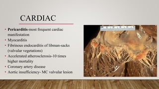 CARDIAC
• Pericarditis-most frequent cardiac
manifestation
• Myocarditis
• Fibrinous endocarditis of libman-sacks
(valvular vegetations)
• Accelerated atherosclerosis-10 times
higher mortality
• Coronary artery disease
• Aortic insufficiency- MC valvular lesion
 