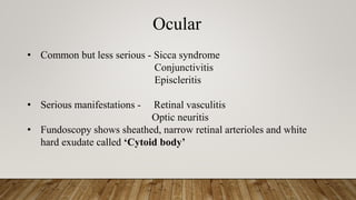 Ocular
• Common but less serious - Sicca syndrome
Conjunctivitis
Episcleritis
• Serious manifestations - Retinal vasculitis
Optic neuritis
• Fundoscopy shows sheathed, narrow retinal arterioles and white
hard exudate called ‘Cytoid body’
 