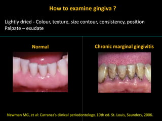 Normal Gingiva Diagnosis and periodontal consideration in fdp | PPTX