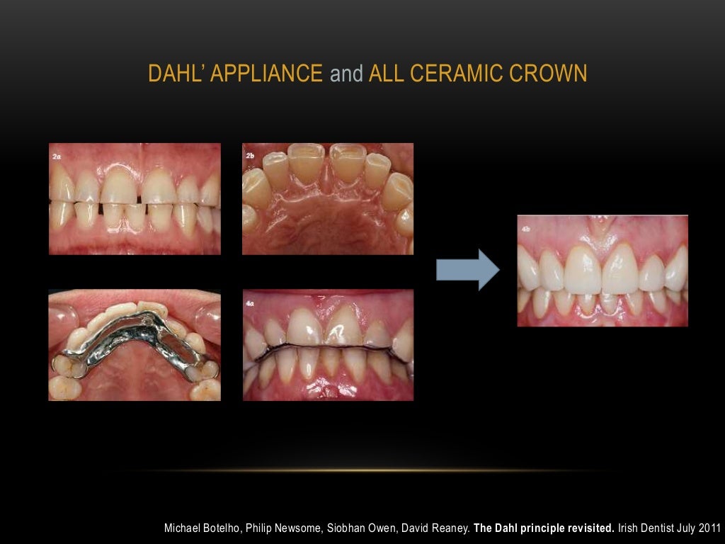 Diagnosis and treatment of choice in restoring vertical dimension