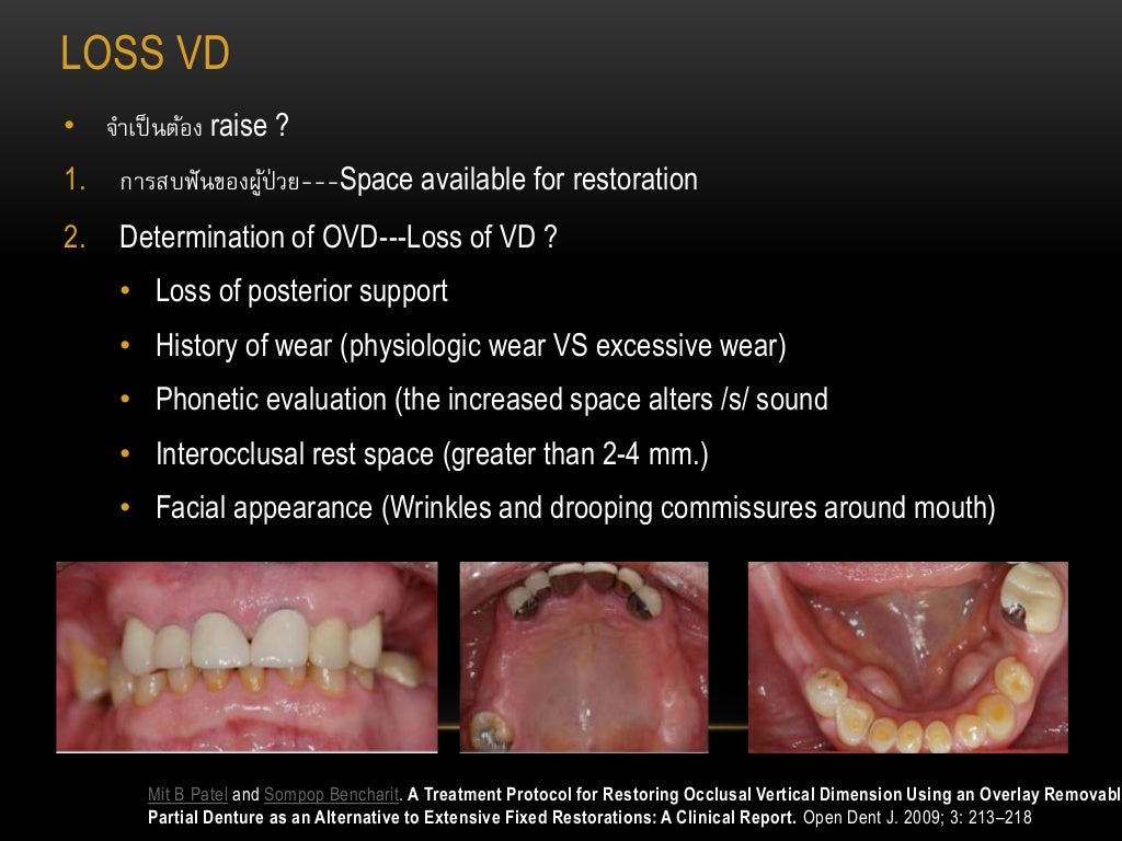 Diagnosis and treatment of choice in restoring vertical dimension