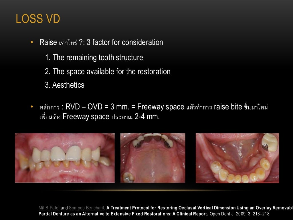 Diagnosis and treatment of choice in restoring vertical dimension