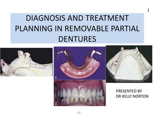 DIAGNOSIS AND TREATMENT
PLANNING IN REMOVABLE PARTIAL
DENTURES
PRESENTED BY
DR KELLY NORTON
100
1
 