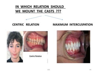 Diagnosis and treatment planning for removable partial dentures | PPTX