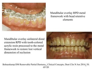 Diagnosis and treatment planning for removable partial dentures | PPTX