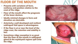 Diagnosis and treatment planning in complete denture.pptx