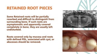 Retained Roots's Extraction Diagnosis and treatment planning in complete denture.pptx