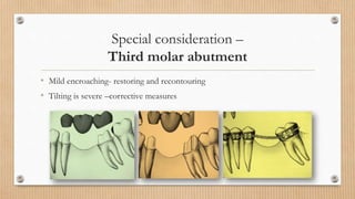 Special considerations – Canine replacement
• No FPD replacing a canine should replace more than one additional tooth.
• B...