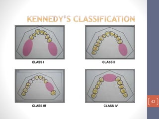 Class Iv Rpd Diagnosis and treatment planning in rpd | PPTX