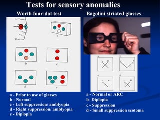 Tests for sensory anomalies Worth four-dot test a - Prior to use of glasses b - Normal  c - Left suppression/ amblyopia Bagolini striated glasses a - Normal or ARC b- Diplopia c - Suppression d - Right suppression/ amblyopia e - Diplopia d - Small suppression scotoma 