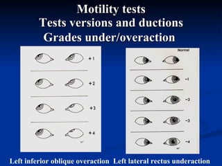 Motility tests Tests versions and ductions Grades under/overaction   Left inferior oblique overaction Left lateral rectus underaction 