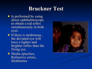 Bruckner Test Is performed by using direct ophthalmoscope to obtain a red reflex simultaneously in both eyes. If there is strabismus , the deviated eye will have a lighter and brighter reflex than the fixing eye. Media opacities, Refractive errors, Strabismus 