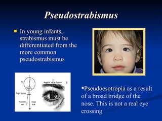 Pseudostrabismus In young infants, strabismus must be differentiated from the more common pseudostrabismus Pseudoesotropia   as a result of a broad bridge of the nose. This is not a real eye crossing 