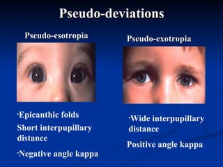 Pseudo-deviations Pseudo-esotropia Pseudo-exotropia Epicanthic folds Short interpupillary distance Negative angle kappa Wide interpupillary distance Positive angle kappa 