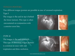 TONGUE POSTURE:
Two different tongue posture are possible in case of oronasal respiration:
Type I
The tongue is flat and its tip is behind
the lower incisors. This type is often
encountered on conjunction with
a anterior cross bite.

TYPE II
The tongue is flat and retracted.
This type of abnormal tongue posture
is common in cases with oral
respiration and disto occlusion.
www.indiandentalacademy.com

 