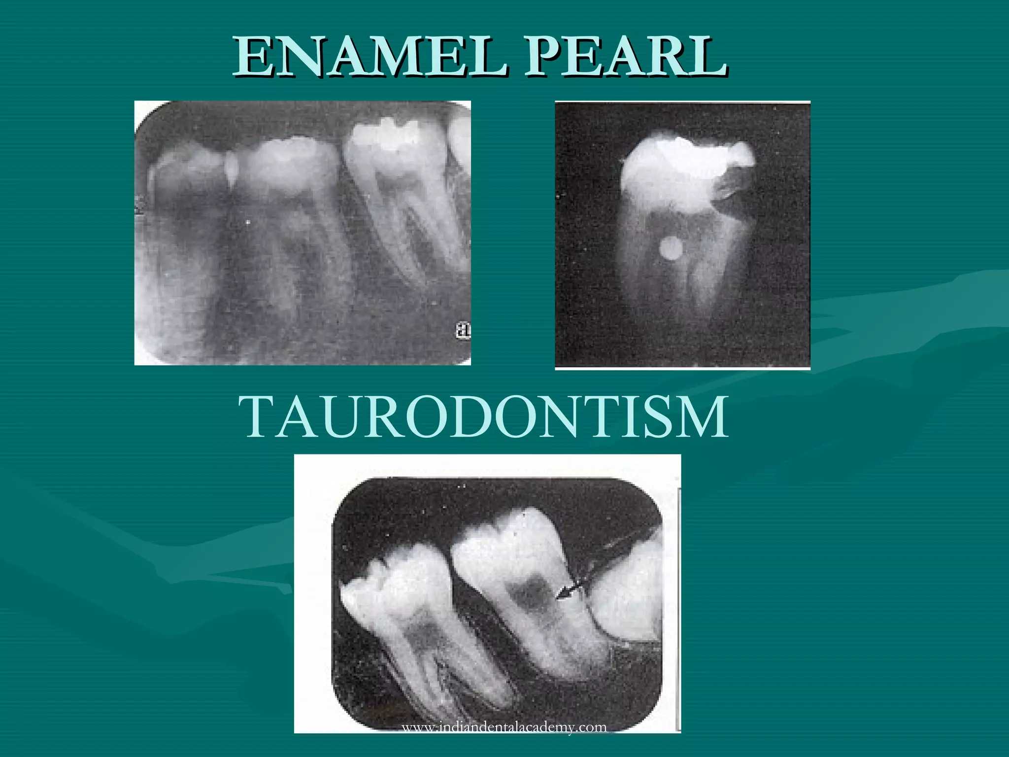 ENAMEL PEARLENAMEL PEARL
TAURODONTISM
www.indiandentalacademy.com
 