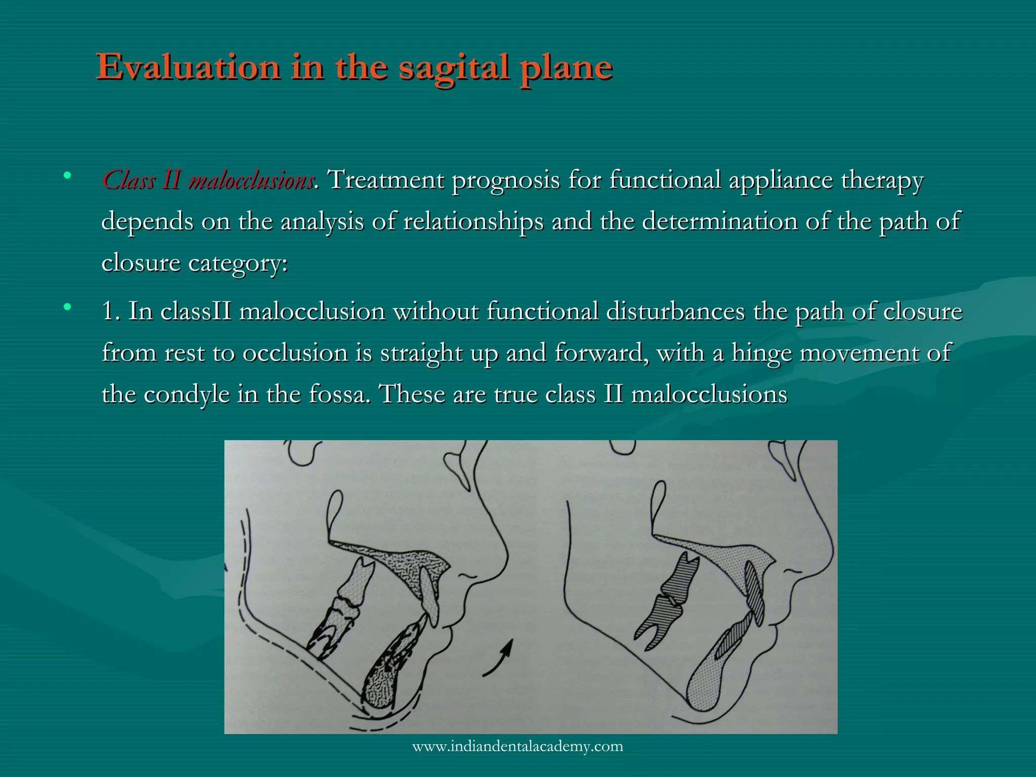 Evaluation in the sagital planeEvaluation in the sagital plane
• Class II malocclusionsClass II malocclusions.. TreatmentTreatment prognosis for functional appliance therapyprognosis for functional appliance therapy
depends on the analysis of relationships and the determination of the path ofdepends on the analysis of relationships and the determination of the path of
closure category:closure category:
• 1. In classII malocclusion without functional disturbances the path of closure1. In classII malocclusion without functional disturbances the path of closure
from rest to occlusion is straight up and forward, with a hinge movement offrom rest to occlusion is straight up and forward, with a hinge movement of
the condyle in the fossa. These are true class II malocclusionsthe condyle in the fossa. These are true class II malocclusions
www.indiandentalacademy.com
 